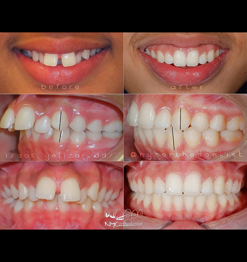 Smile before and after orthodontic treatment for class two bite alignment issues