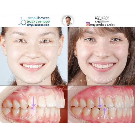 Smile before and after orthodontic treatment for overbite
