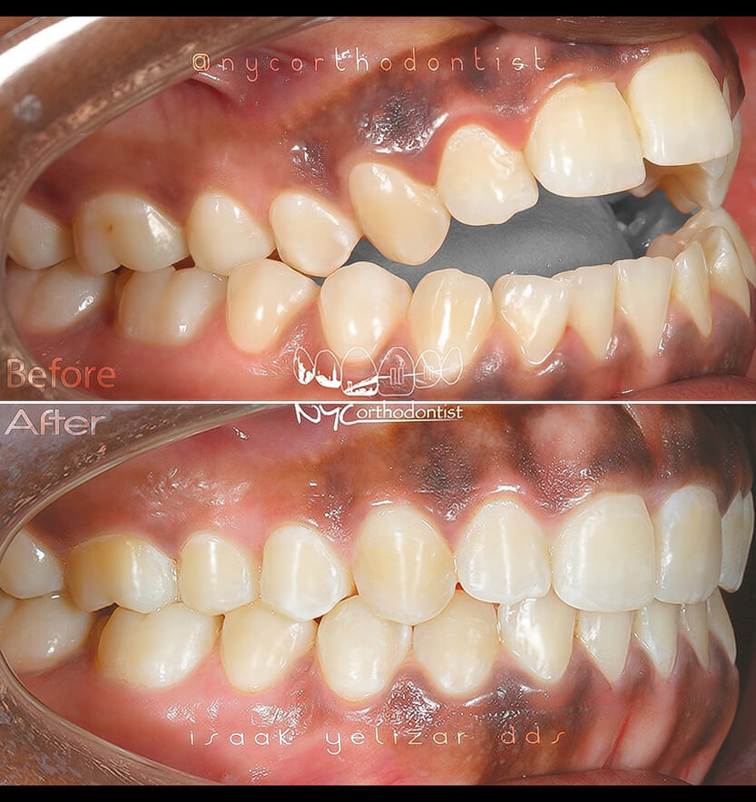 Smile before and after treatment for severe overbite