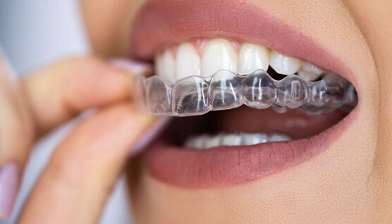 Close-up of woman’s mouth as she places clear aligner on her teeth  