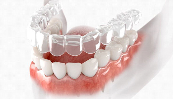 Illustration showing clear aligner for lower dental arch 