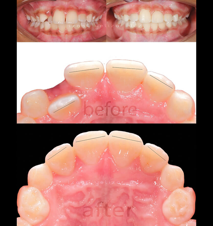 Closeup and intraoral images of smile before and after crossbite treatment