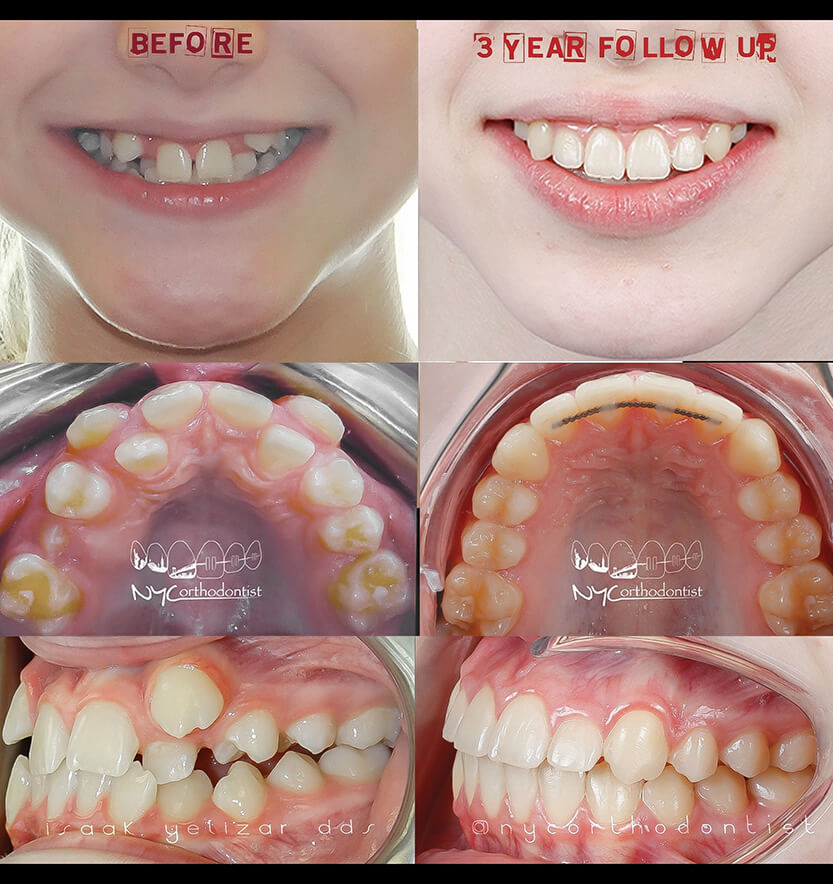 Young patient before and after treatment for severe crossbite