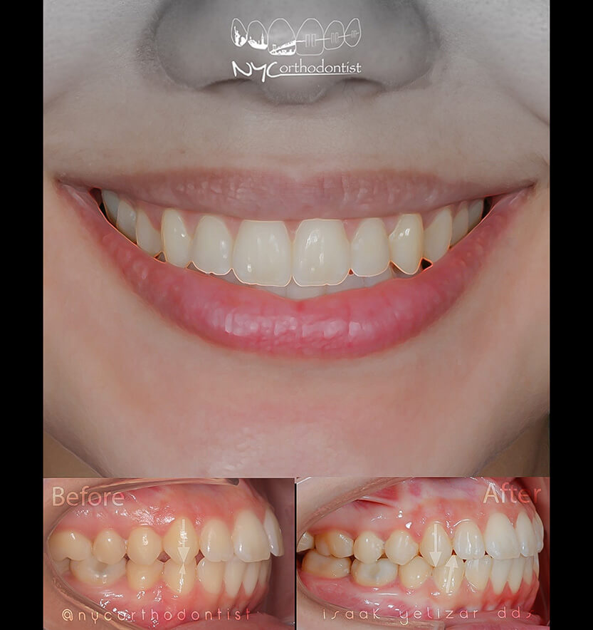 Smile before and after treatment for severe class two bite alignment issues