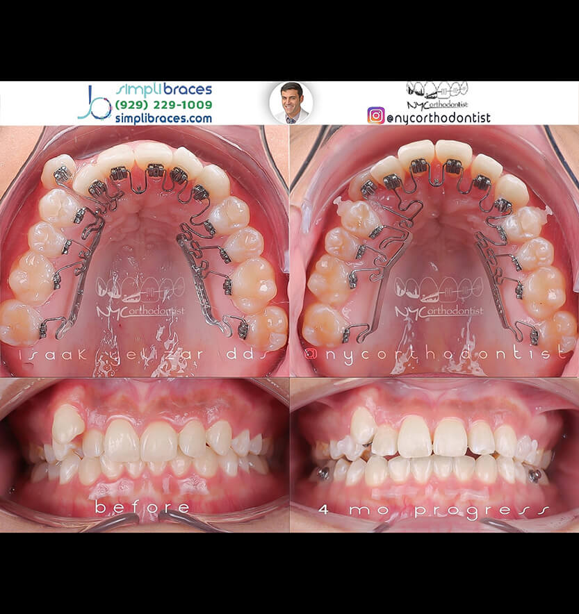 Patient's smile before and after crowding treatment