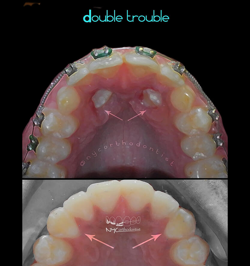 Inside of teeth showing two impacted teeth before and flawless smile after impacted teeth treatment