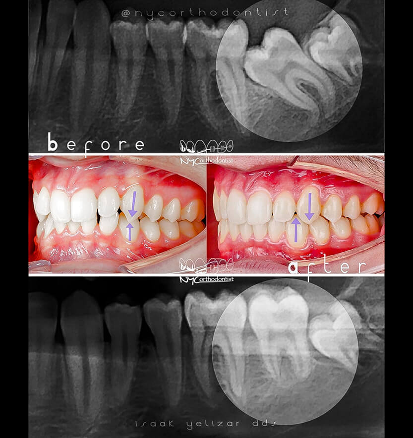 X-ray of teeth and side view of smile before and after treatment for impacted teeth
