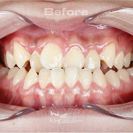Close up of crooked teeth before orthodontic treatment in Queens