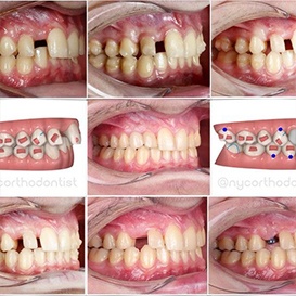 Close up of teeth before and after orthodontic treatment