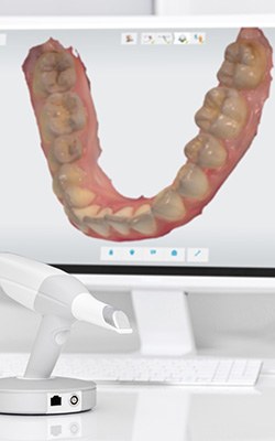 digital image of patients teeth in corona