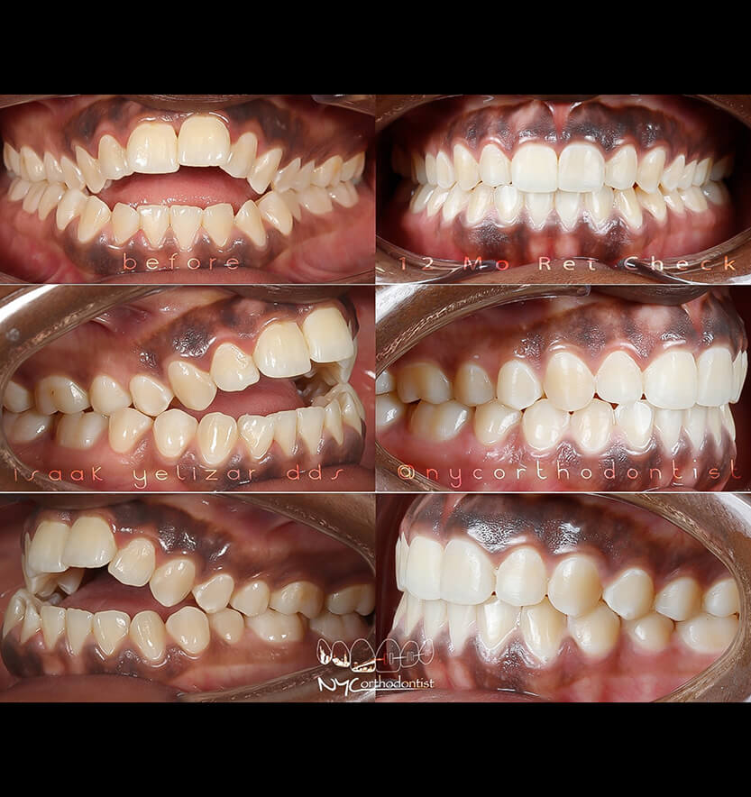 Front and side views of smile before and after treatment for severe overbite