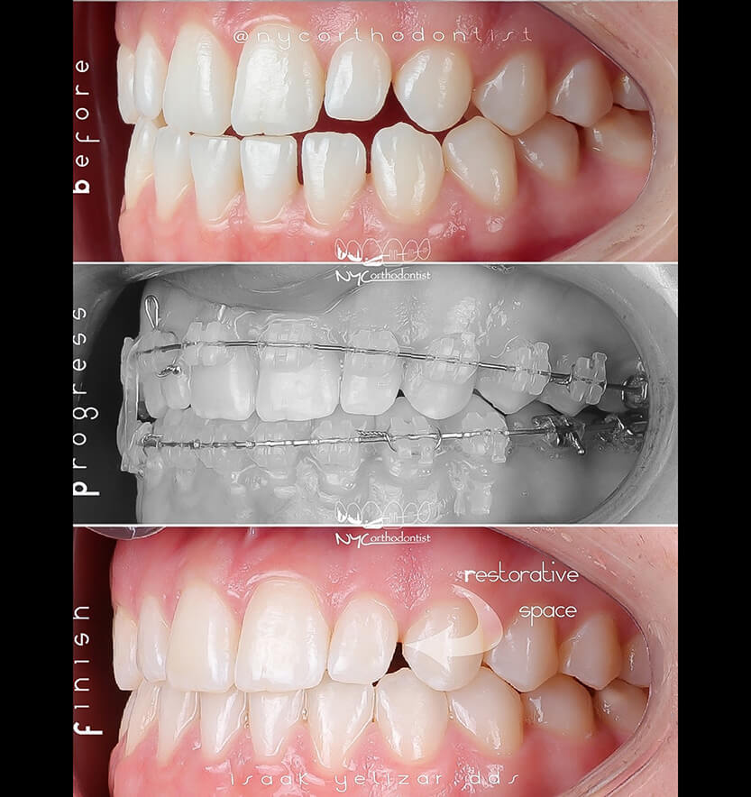 Side view of smile before during and after pegged tooth treatment