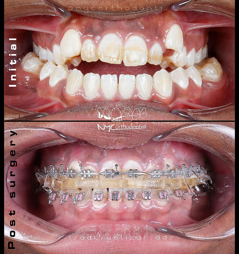 Closeup of smile before and after surgical bite alignment