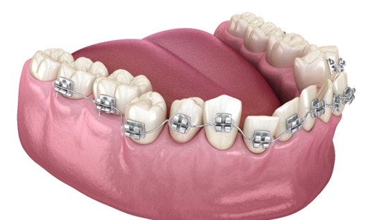 How are Metal and Ceramic Braces Different?  Kossowan OrthodonticsKossowan  Orthodontics