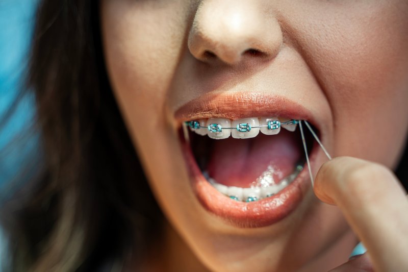 Teen wears rubber bands on braces